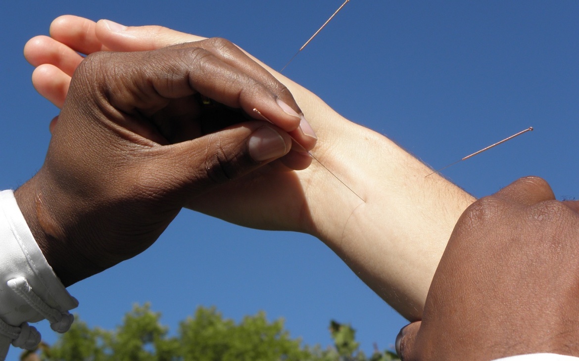 ACUPUNCTURE